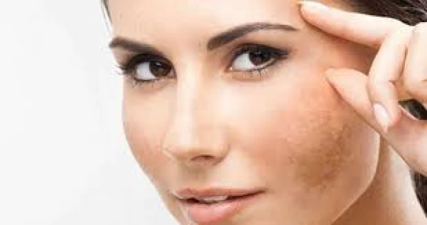 Restore Your Glow: The Ultimate Guide to Melasma Treatment in Islamabad