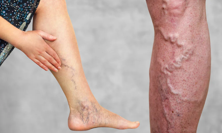 The Difference Between Varicose Veins and Spider Veins