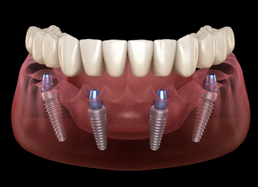 Restore Your Smile with All-on-4 Dental Implants