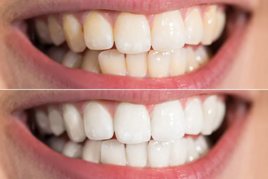 Why Are Professional Teeth Whitening Treatments More Effective?