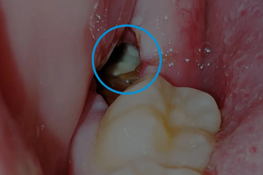 How Long Is Recovery After Wisdom Teeth Removal?