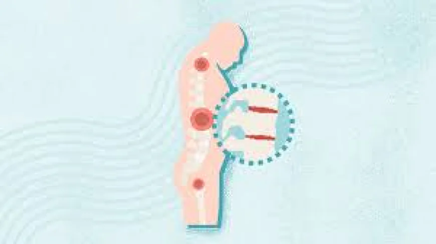 Celebrex 200mg: Relief for Ankylosing Spondylitis