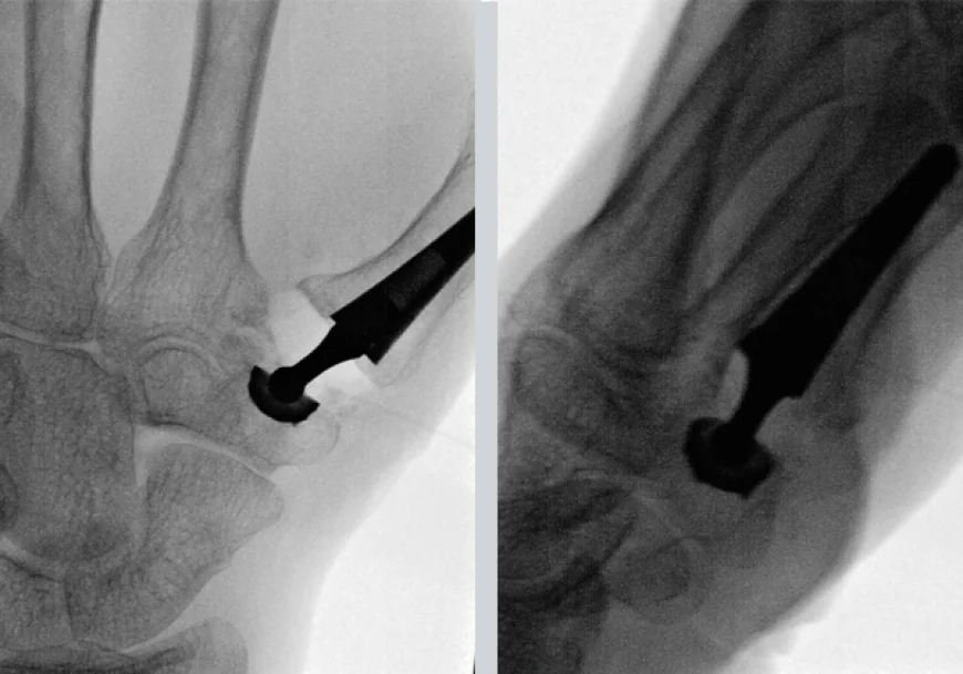 CMC Joint Replacement Surgery – Restore Thumb Mobility with Expert Care in London