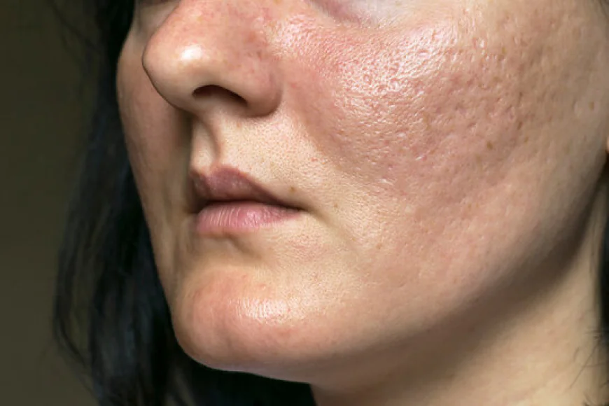 The Latest Innovations in Acne Scar Treatment in Islamabad