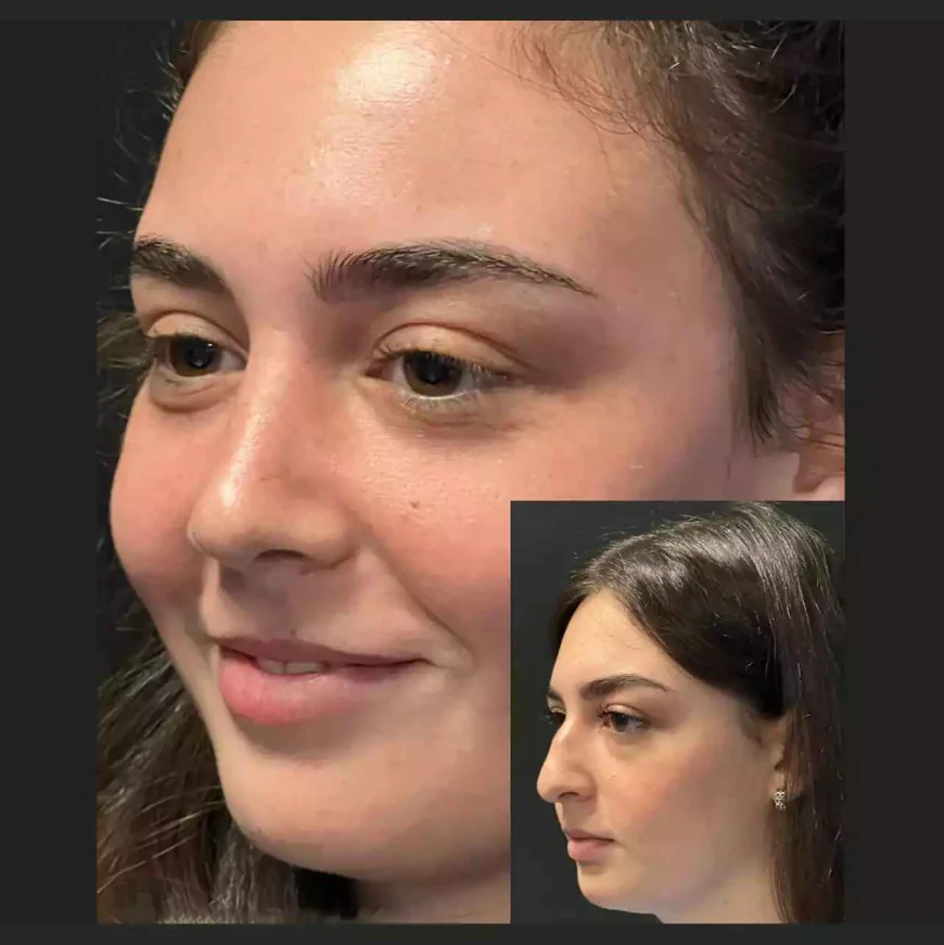 Best Doctors in Dubai for Natural Rhinoplasty Looks