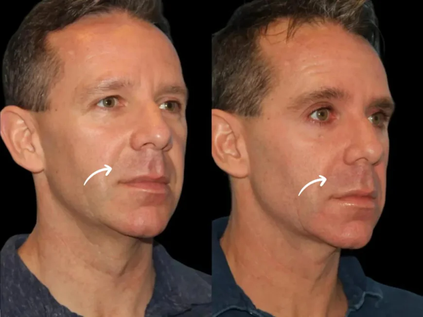 Best Doctors in Dubai Highlight Sleep Impact on Sculptra fillers