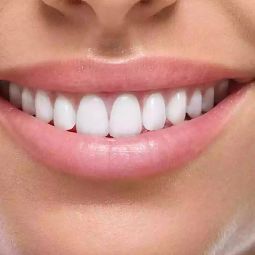 Composite Veneers: Are They Suitable for Children?