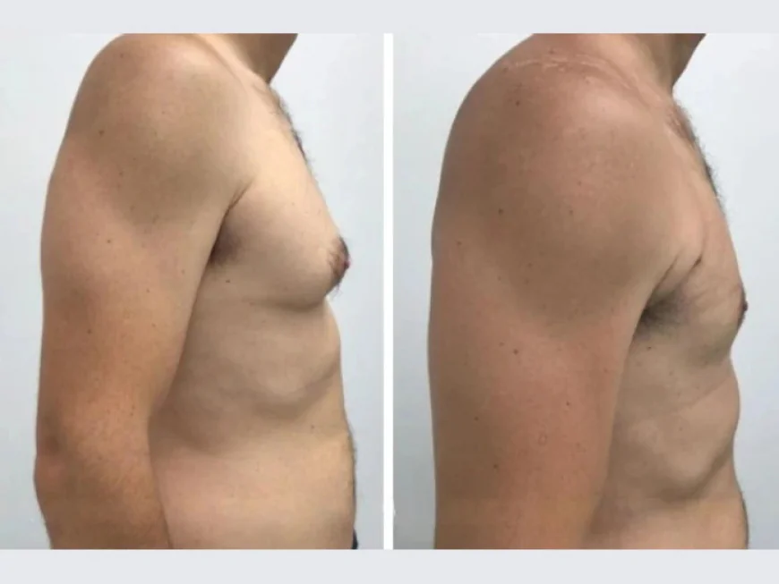 Understanding Gynecomastia Surgery in Dubai: Step-by-Step