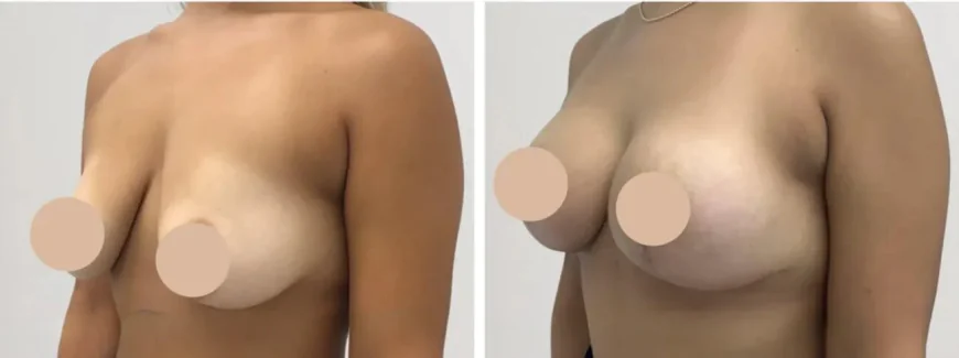 Comparing Techniques: Breast Lift Options in Dubai