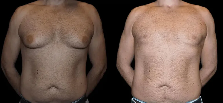 Gynecomastia for Overweight Patients in Dubai