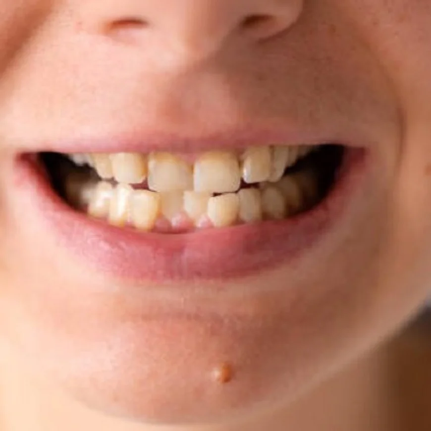 How to Prevent Crowded Teeth from Returning?