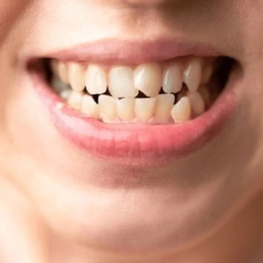 What’s the Most Comfortable Crowded Teeth Treatment?