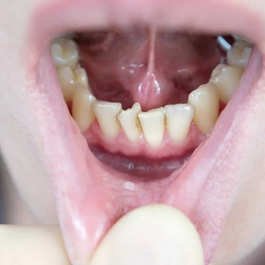 Can Crowded Teeth Be Fixed in Teenagers?