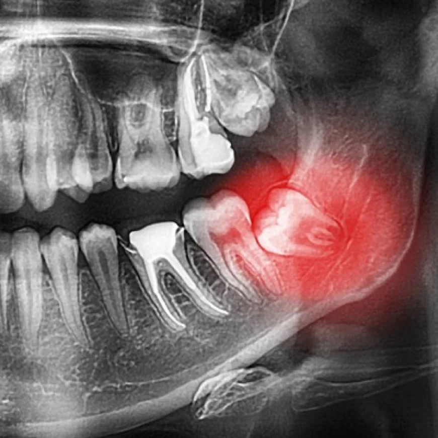 How a Dental Panoramic X-Ray Helps in Implants