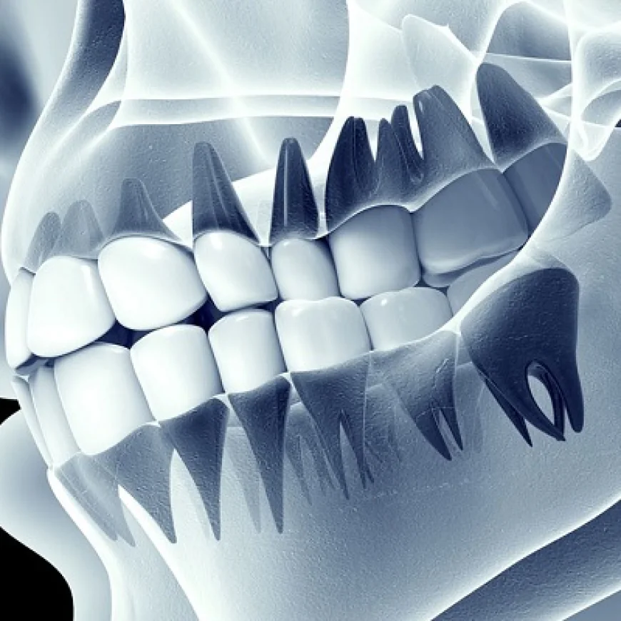 Dental Panoramic X-Ray for Dentures Planning