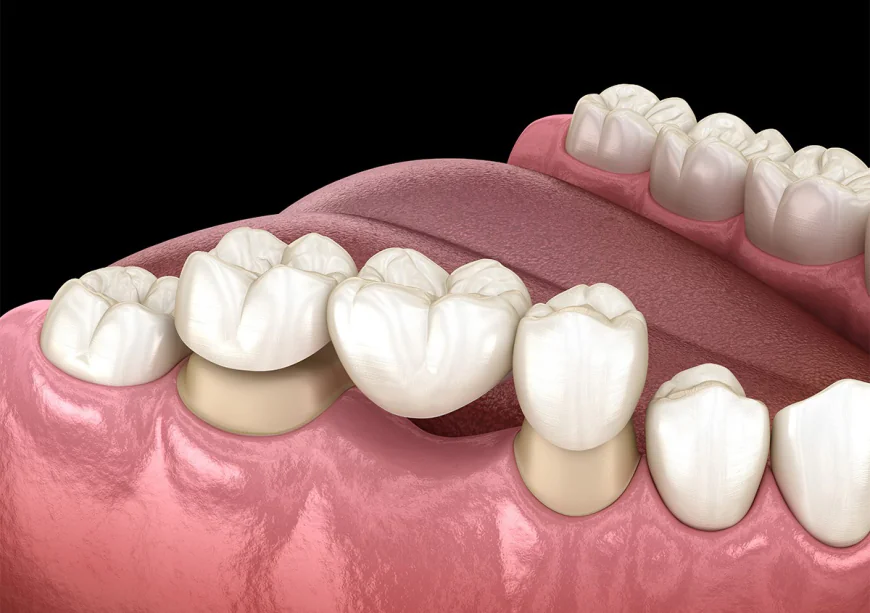 Improve Smiles With Crowns and Bridges