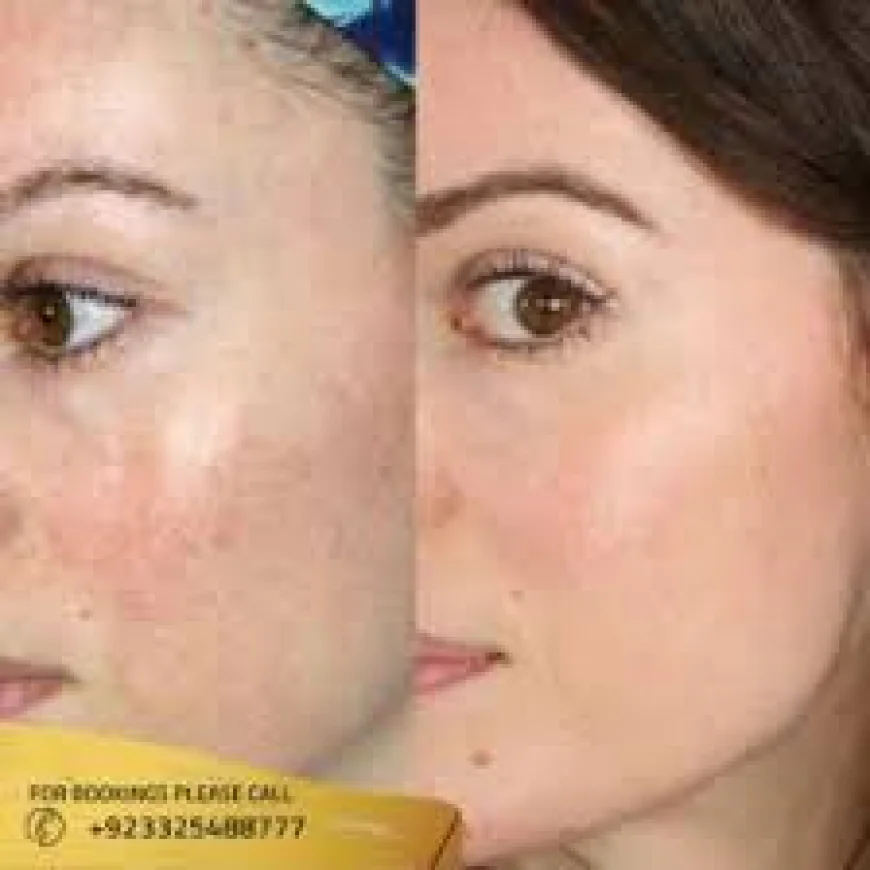 Microneedling Treatment in Islamabad – The Secret to Flawless Skin