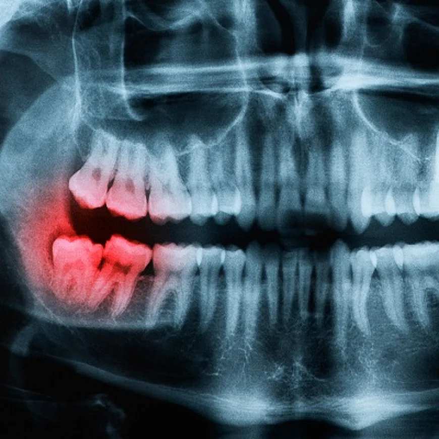 When Do You Need a Dental Panoramic X-Ray?
