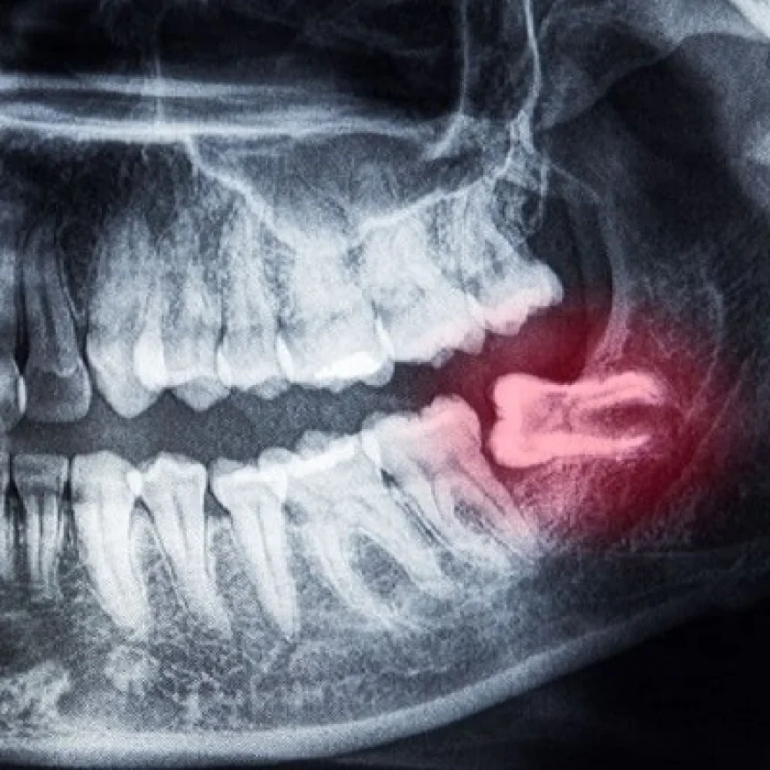 Panoramic X-Ray for Tooth Implant Planning
