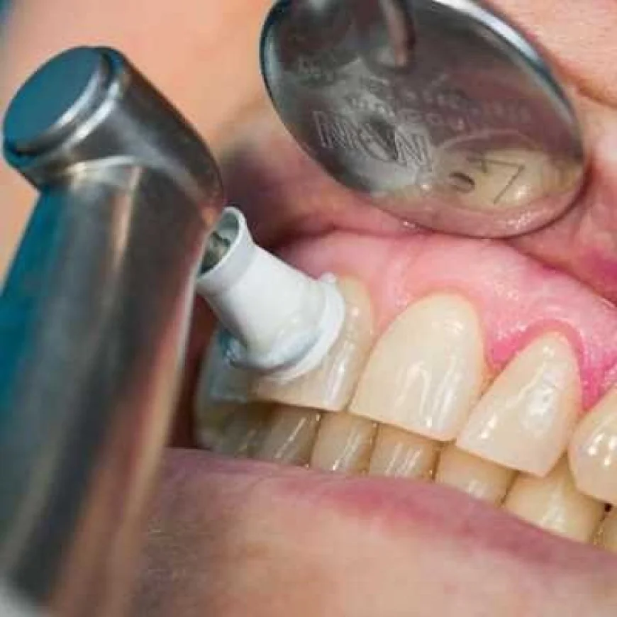Teeth Cleaning for Yellow Teeth Removal