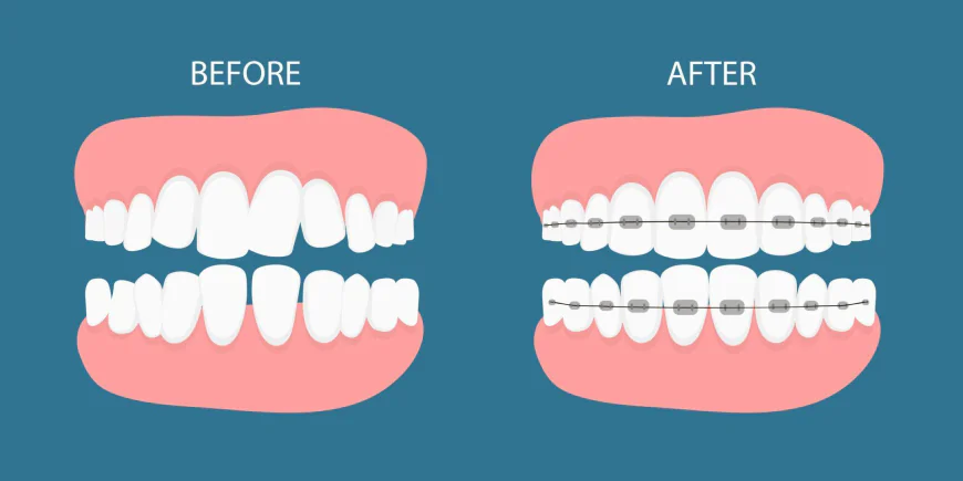 Teeth Braces Before and After: Key Stages of Dental Treatment