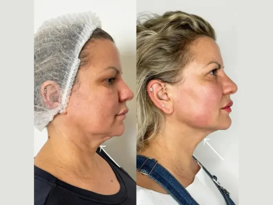 How the Best Plastic Surgeons in Dubai Combine Endolift with Other Aesthetic Treatments