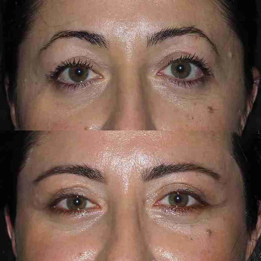 Eye Bag Removal Aftercare Routine by the Best Doctors in Dubai