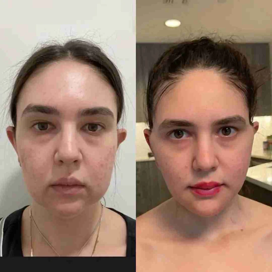 How to Reduce Swelling After Buccal fat removal Surgery in Dubai