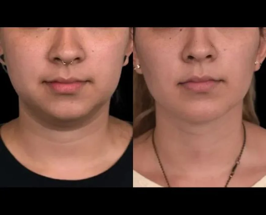 Exploring Non-Surgical Options for Double Chin Removal by the Best Double Chin Removal Surgeon in Dubai