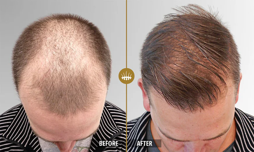 Dr. Naveed Take on Guaranteed Hair Transplant Results