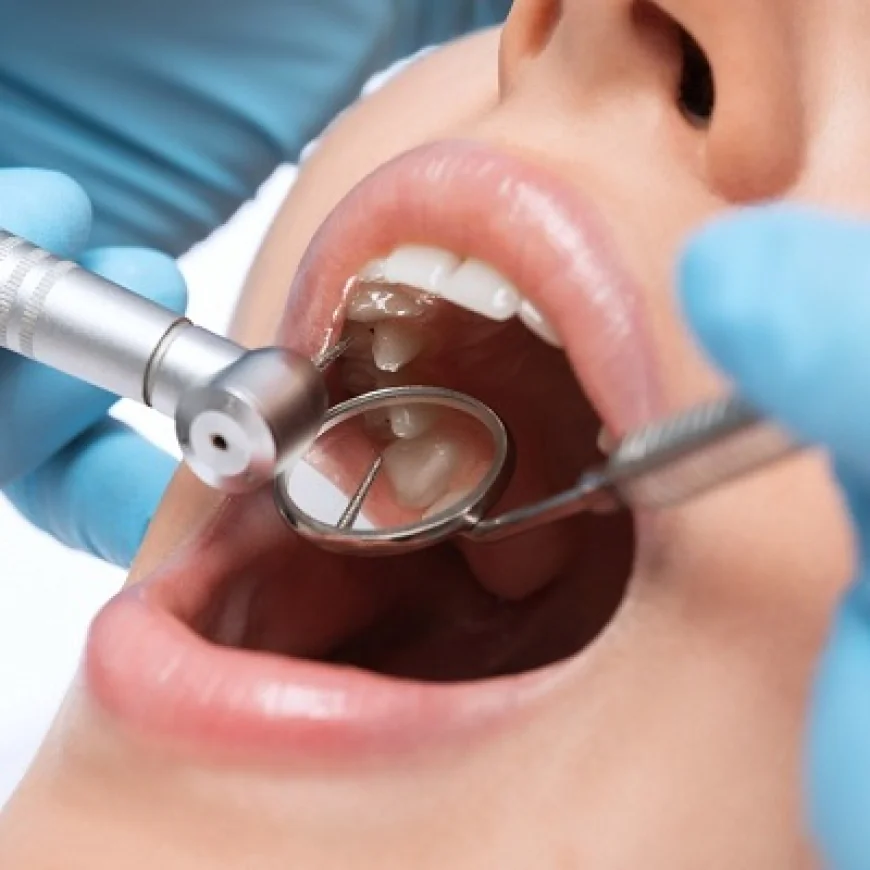 Benefits of Tooth-Colored Dental Tooth Fillings