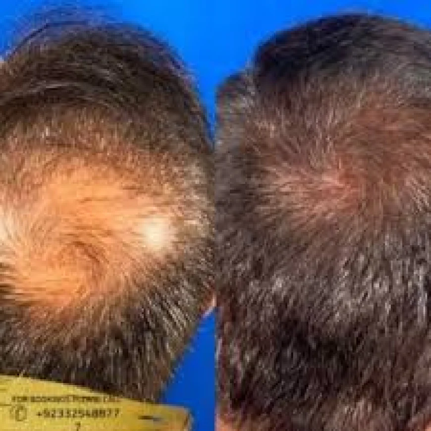 Alopecia Areata Treatment in Islamabad – Regain Hair and Confidence