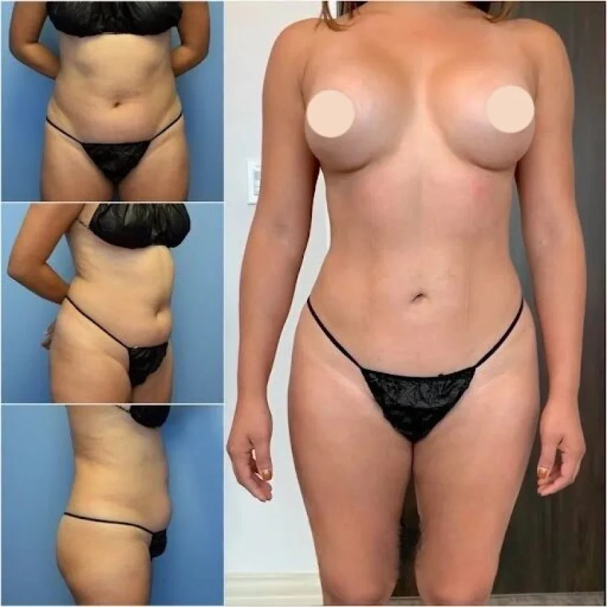 Best Body Contouring Surgeon in Dubai: Precision and Expertise Combined