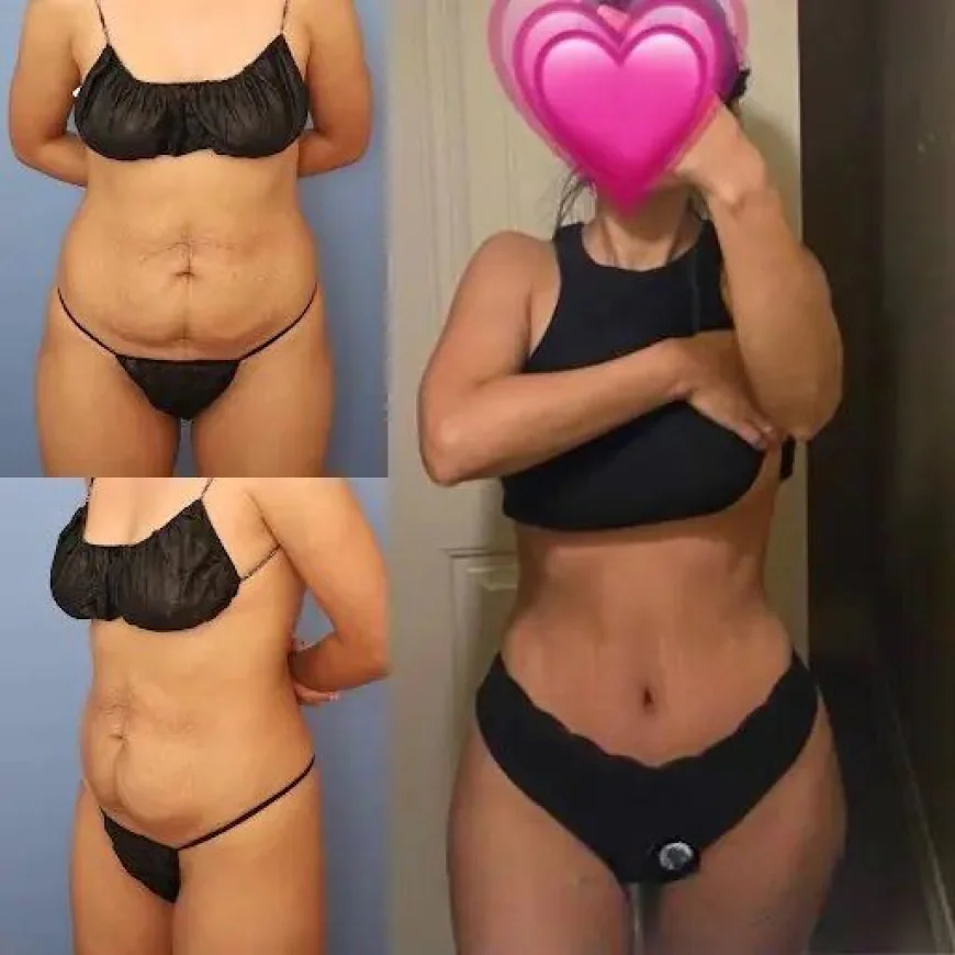 Tummy Tuck Recovery in Dubai: What You Should Know for a Smooth Healing Process