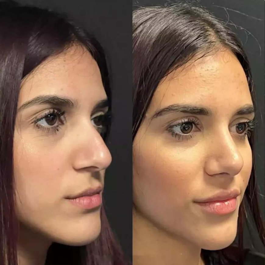 Rhinoplasty in Dubai Before and After Transformations