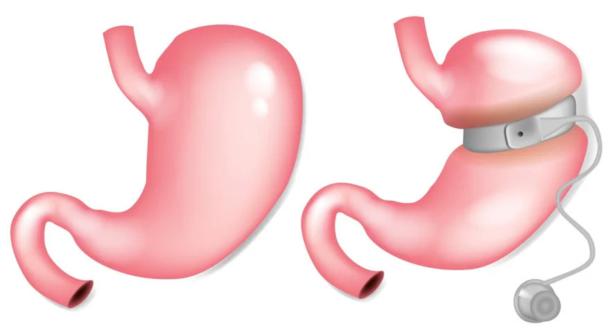 What Is Gastric Balloon Placement?