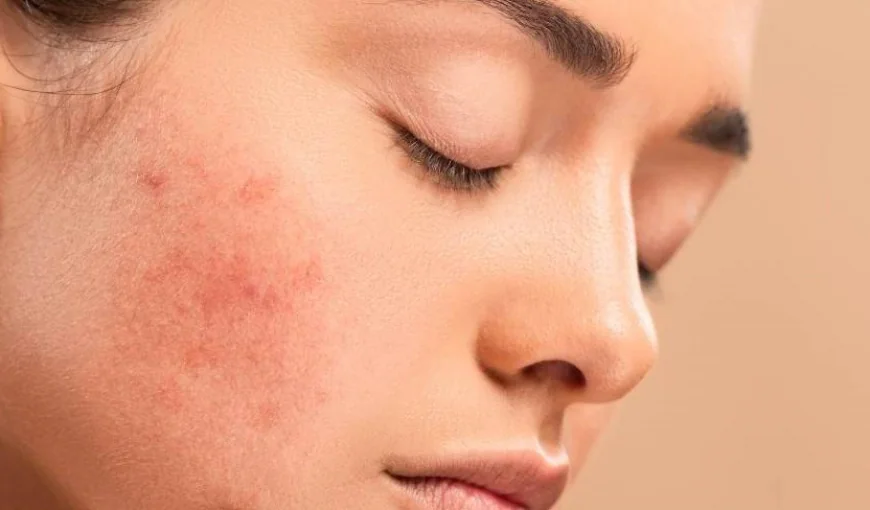 The Link Between Hormones and Skin Pigmentation