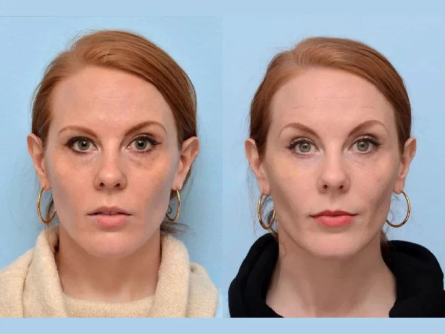 Botox Treatment in Dubai: How Long Do the Results Really Last?
