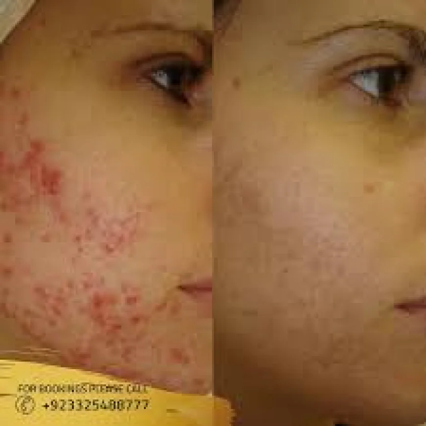 Acne Scars Treatment in Islamabad – A Step Toward Flawless Skin