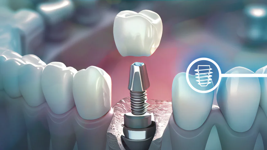 How Long Do Dental Implants Last?