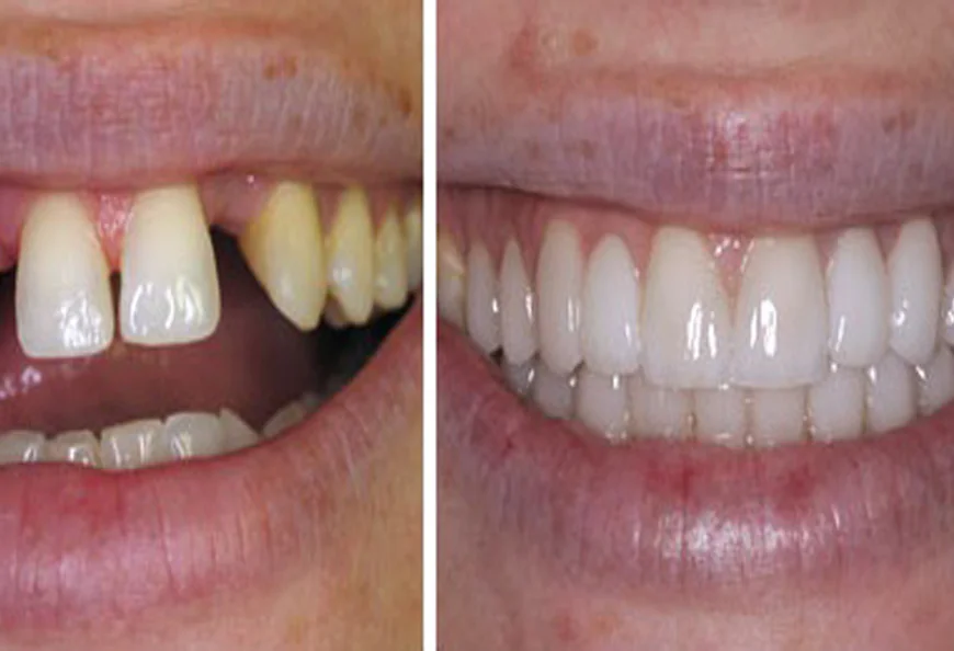 A Complete Guide to Restoring Oral Health