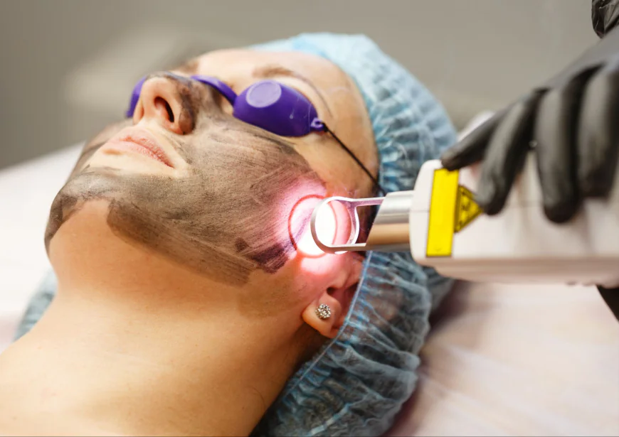 PICO Laser for Men in Islamabad – Not Just for Women