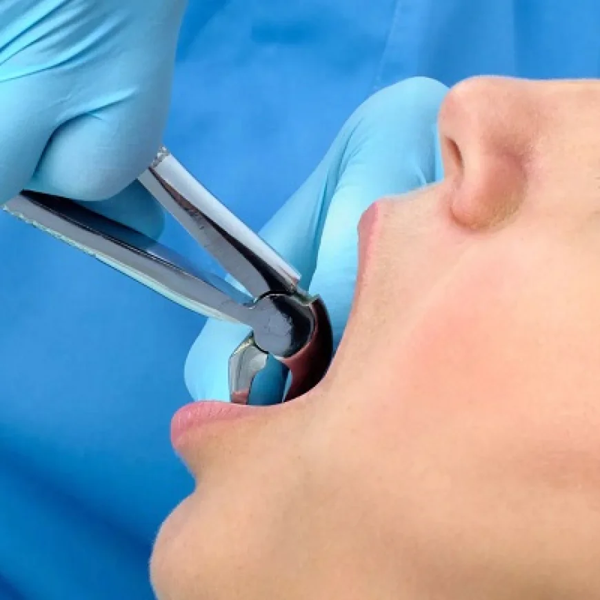 What to Expect After Removing Wisdom Teeth