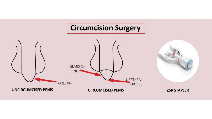 Circumcision Surgery in Mumbai: Benefits, Risks, and Recovery