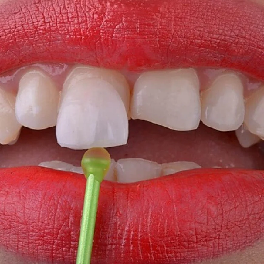 Can E-Max Veneers Fix Gaps Between Teeth?