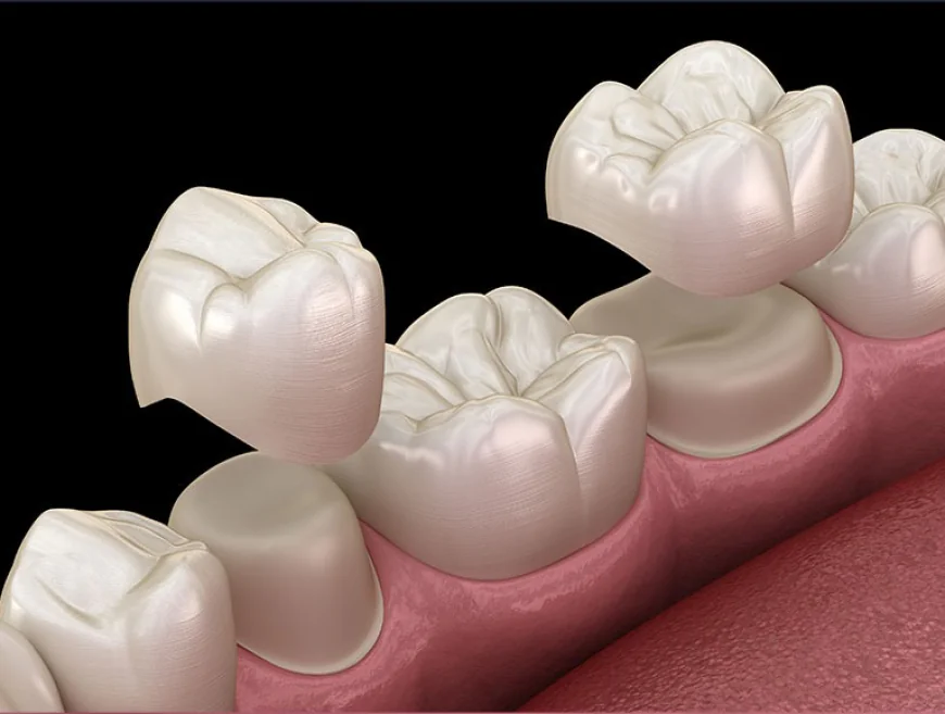 Dental Crowns in Levittown: Types, Costs, and Treatment Timeline