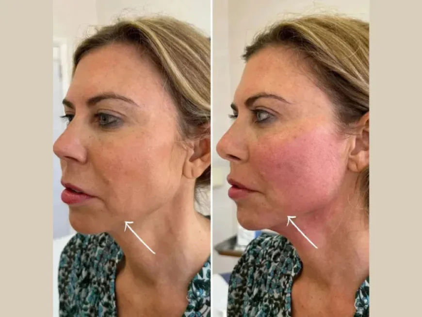 Why Best Plastic Surgeons in dubai Recommend Endolift for Skin Tightening
