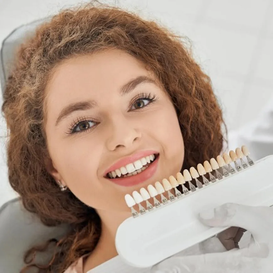 Do E-Max Veneers Match Skin Tone?