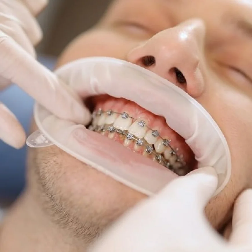 Orthodontists’ Guide to Retainers and Care