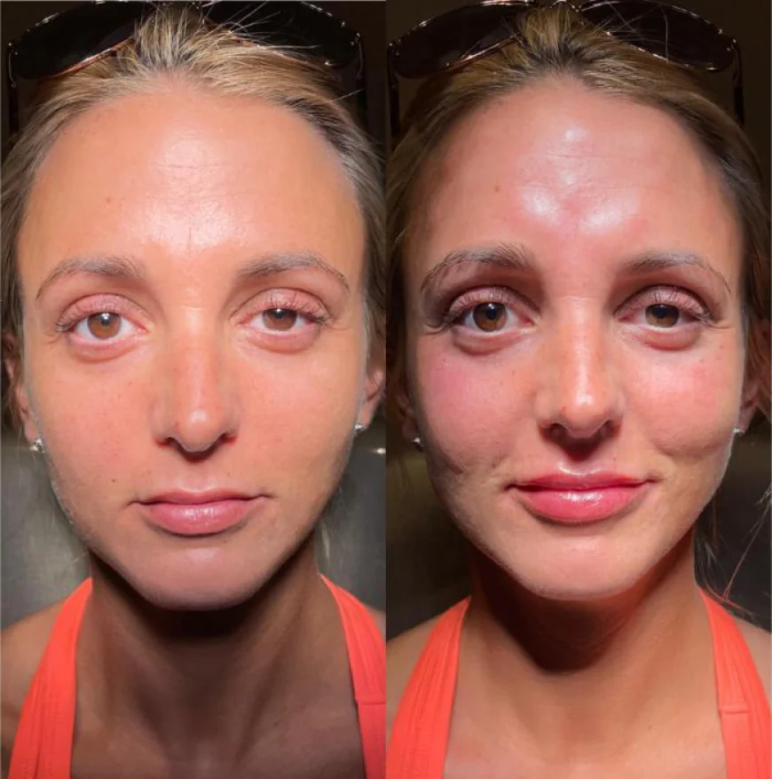 Dermal Fillers in Islamabad with Dr. Ayusha